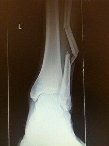 David's Broken Leg  X-ray